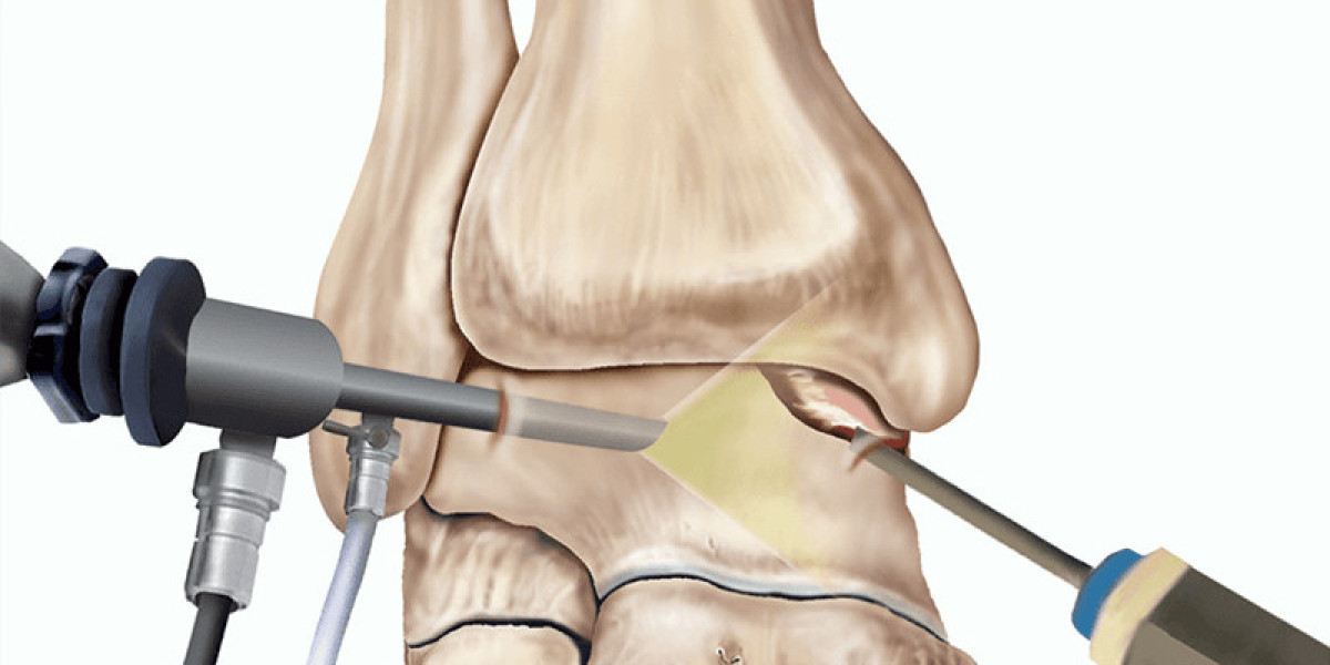 Advanced Ankle Arthroscopy Treatment in Delhi | Expert Care by Dr. Mathur Orthopaedic