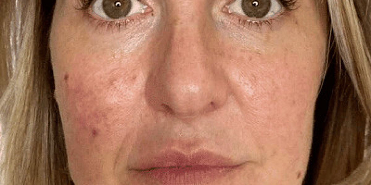 Which Pimples Treatment Is Best Suited for Teenagers?