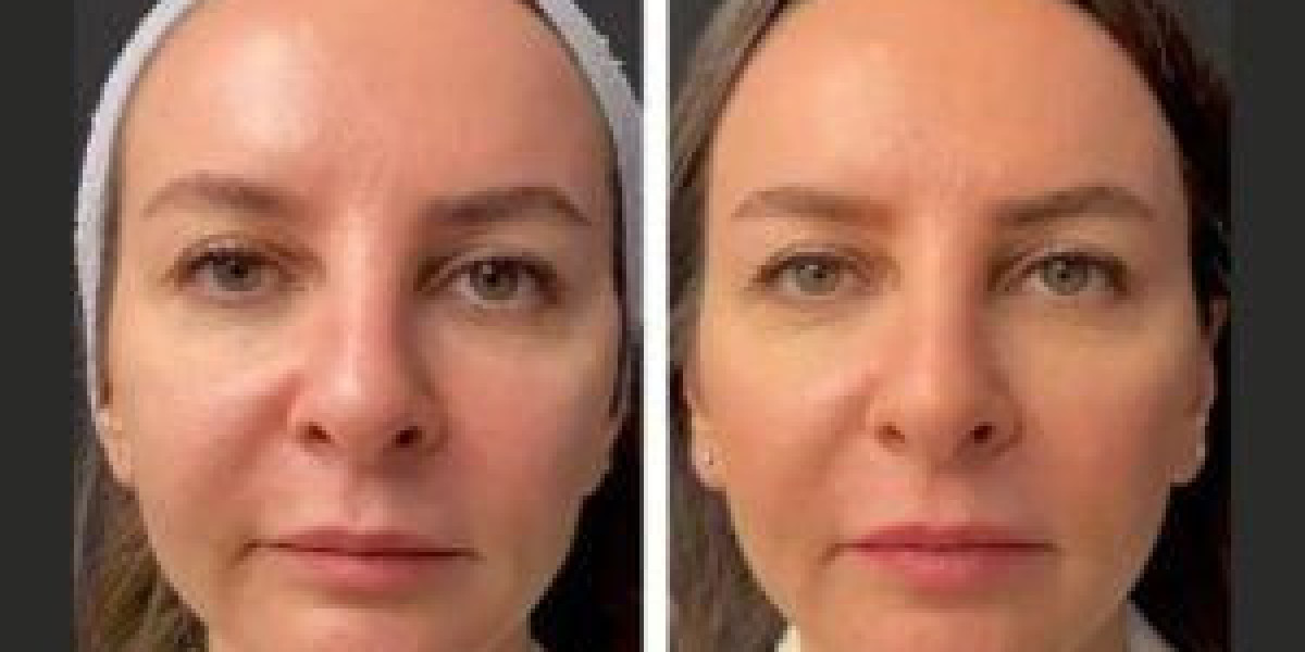 Mesotherapy in Dubai: Redefine Your Skin’s Youthful Glow