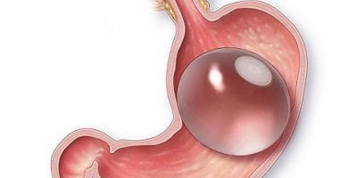 Is the Gastric Balloon a Safe Weight-Loss Option?