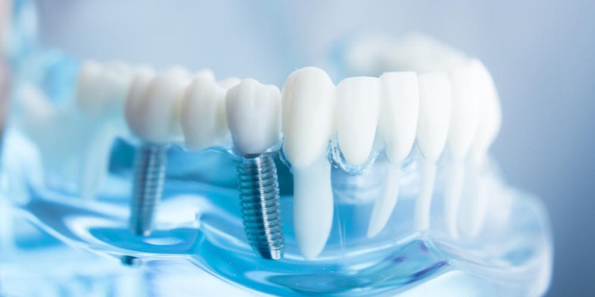 Discover Premium Dental Implants in Bahrain at Aesthetica Dr. Reem AlShaiba Dental Center – Your Trusted Destination for