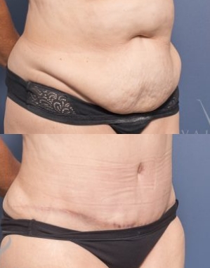 Abdominoplasty Cosmetic Surgeon Brisbane - Dr Raymond Goh