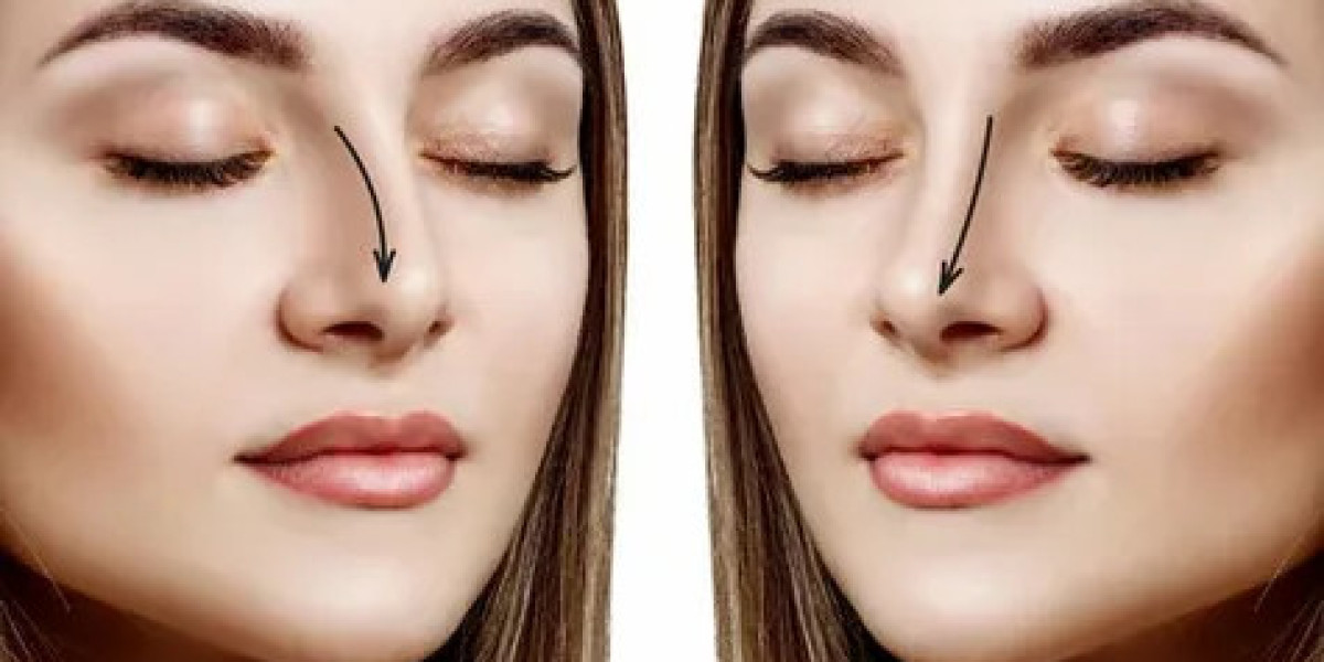 Rhinoplasty in Dubai: Long-Term Care and Maintaining Results