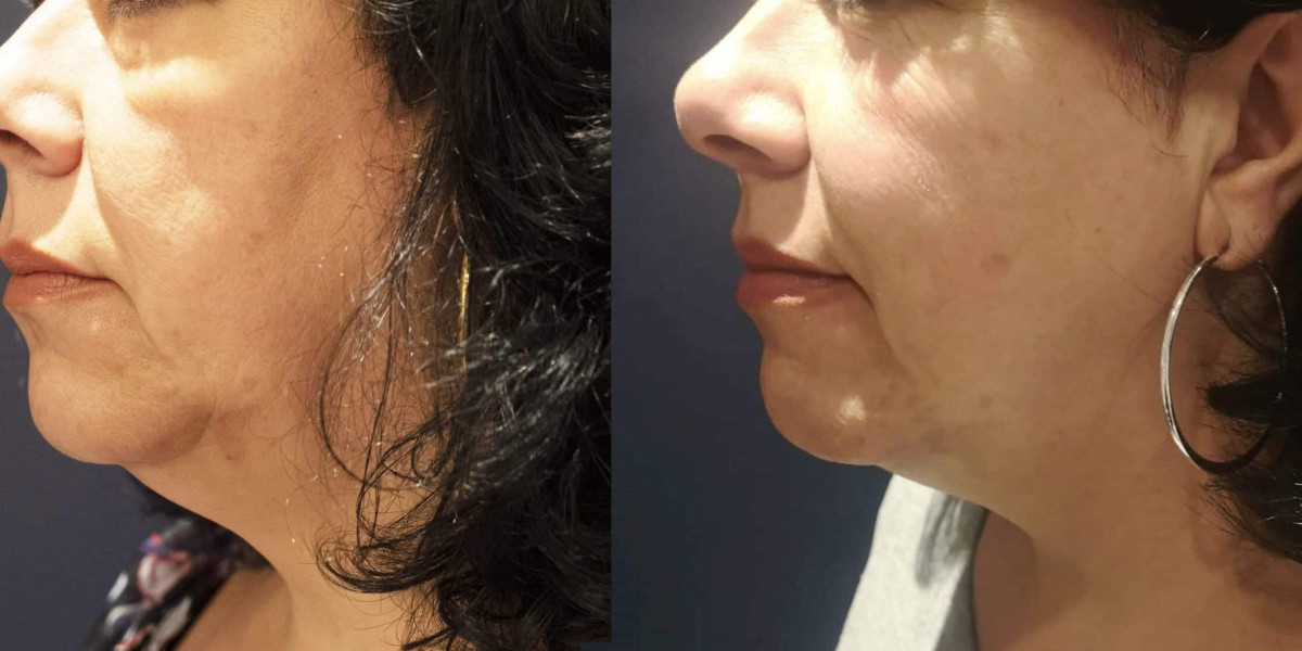 Vaginal Rejuvenation Treatment for Confidence Boost