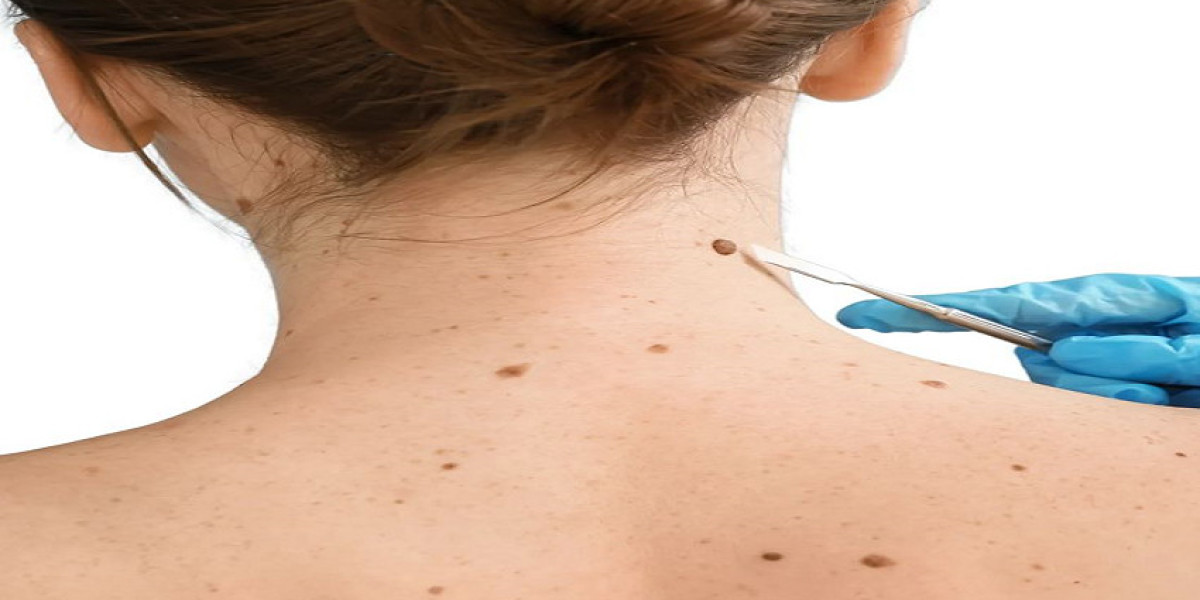 Mole Removal in Dubai: Effective Treatment for Multiple Moles