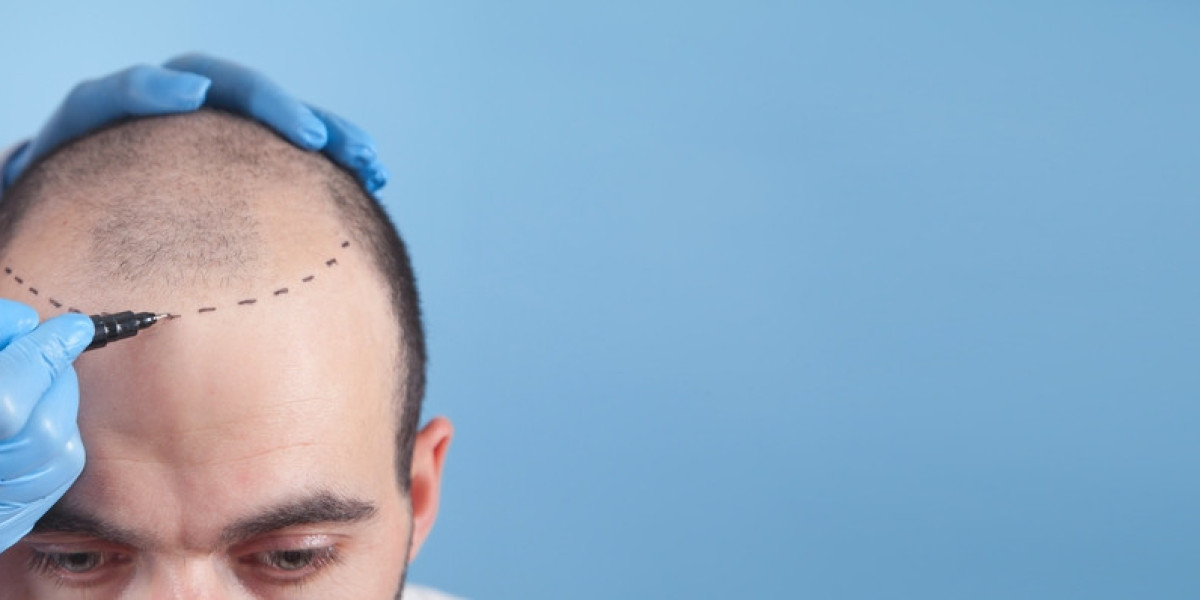 Hair Transplant in Gurgaon: What Makes It a Top Choice for Natural Results?