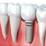 Best Dental Implants near me