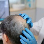 Hair Transplant in Al Ain